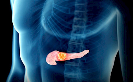 新筛查工具可识别95%的一期胰腺癌细胞